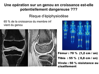 Une opération sur un genou en croissance est-elle 
potentiellement dangereuse ??? 
Risque d’épiphysiodèse 
Fémur : 70 % (1,2 cm / an) 
Tibia : 55 % ( 0,8 cm / an) 
Virole : 50 % résistance au 
cisaillement 
65 % de la croissance du membre inf 
vient du genou 
 
