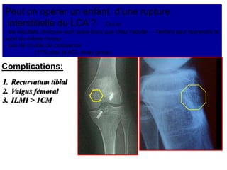 Peut on opérer un enfant d’une rupture 
interstitielle du LCA ? Oui si: 
- les résultats cliniques sont aussi bons que chez l’adulte - - l’enfant peut reprendre le 
sport au même niveau 
- pas de trouble de croissance 
(11% pour le ACL study group) 
Complications: 
1. Recurvatum tibial 
2. Valgus fémoral 
3. ILMI > 1CM 
 