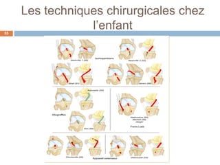 Les techniques chirurgicales chez 
l’enfant 
55 
 