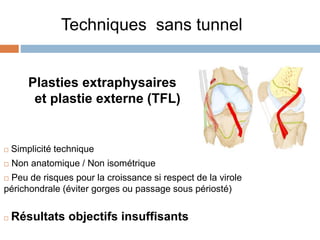 Techniques sans tunnel 
Plasties extraphysaires 
et plastie externe (TFL) 
 Simplicité technique 
 Non anatomique / Non isométrique 
 Peu de risques pour la croissance si respect de la virole 
périchondrale (éviter gorges ou passage sous périosté) 
 Résultats objectifs insuffisants 
 