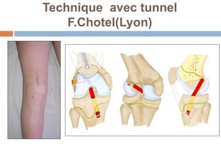 Technique avec tunnel 
F.Chotel(Lyon) 
 