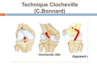 Technique Clocheville 
(C.Bonnard) 
 