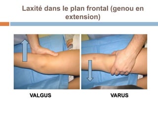 Laxité dans le plan frontal (genou en 
extension) 
VALGUS VARUS 
 