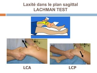 Laxité dans le plan sagittal 
LACHMAN TEST 
LCA LCP 
 