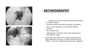 Legg-Calvé-Perthes Disease of hip .pptx