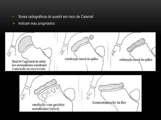 • Sinais radiográficos do quadril em risco de Caterrall
 Indicam mau prognóstico
 