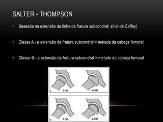 SALTER - THOMPSON
• Baseada na extensão da linha de fratura subcondral( sinal de Caffey)
• Classe A - a extensão da fratura subcondral < metade da cabeça femoral
• Classe B - a extensão da fratura subcondral > metade da cabeça femural
 