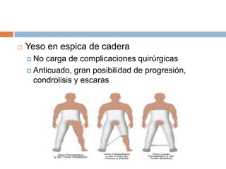 Enfermedad de Legg Calve Perthes | PPTX