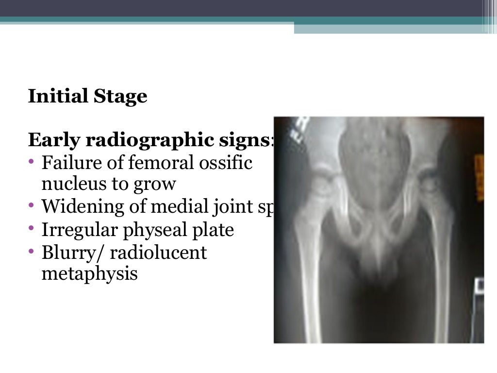 Legg calve perthes