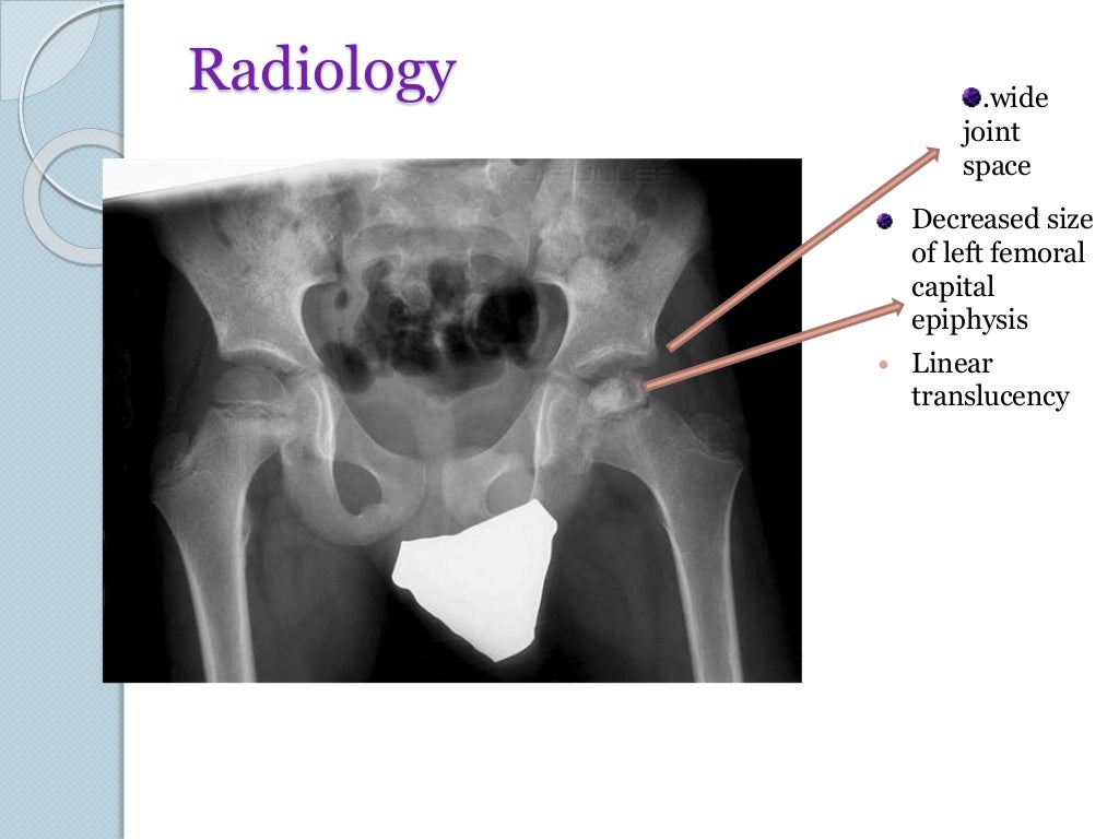 Legg calve perthes disease