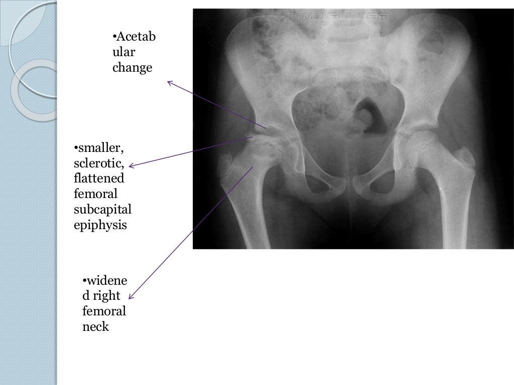 Legg calve perthes disease