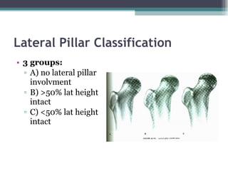 3 groups: A) no lateral pillar involvment B) >50% lat height intact C) <50% lat height intact Lateral Pillar Classification 