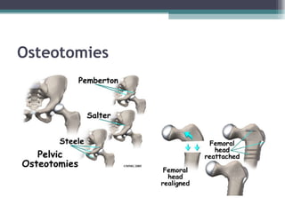 Osteotomies 