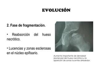 EVOLUCIÓN
2. Fase de fragmentación.
• Reabsorción del hueso
necrótico.
• Lucencias y zonas esclerosas
en el núcleo epifisario.
Aumento importante de densidad
(esclerosis) del hueso necrótico y la
aparición de zonas lucentes alrededor.
 