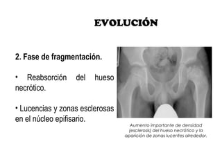 EVOLUCIÓN
2. Fase de fragmentación.
• Reabsorción del hueso
necrótico.
• Lucencias y zonas esclerosas
en el núcleo epifisario.
Aumento importante de densidad
(esclerosis) del hueso necrótico y la
aparición de zonas lucentes alrededor.
 