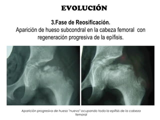 EVOLUCIÓN
3.Fase de Reosificación.
Aparición de hueso subcondral en la cabeza femoral con
regeneración progresiva de la epífisis.
Aparición progresiva de hueso "nuevo" ocupando toda la epífisis de la cabeza
femoral
 