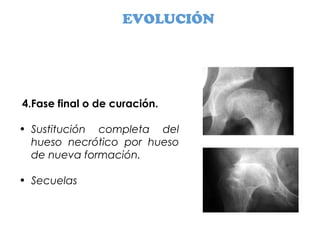 EVOLUCIÓN
4.Fase final o de curación.
• Sustitución completa del
hueso necrótico por hueso
de nueva formación.
• Secuelas
 