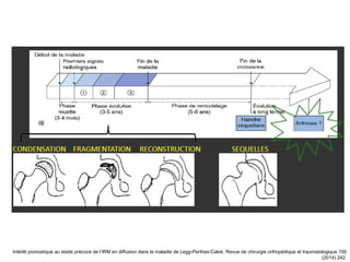 Intérêt pronostique au stade précoce de l’IRM en diffusion dans la maladie de Legg-Perthes-Calvé. Revue de chirurgie orthopédique et traumatologique 100
(2014) 242
 