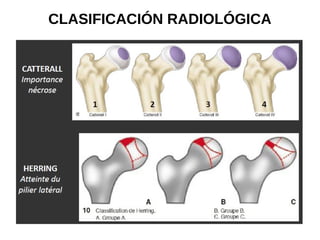 CLASIFICACIÓN RADIOLÓGICA
 