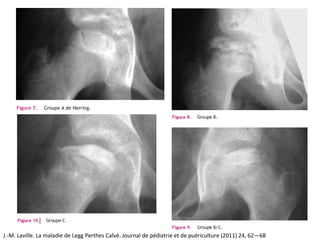 J.-M. Laville. La maladie de Legg Perthes Calvé. Journal de pédiatrie et de puériculture (2011) 24, 62—68
 