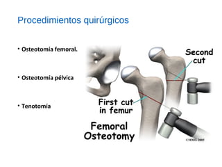 Procedimientos quirúrgicos
• Osteotomía femoral.
• Osteotomía pélvica
• Tenotomía
 