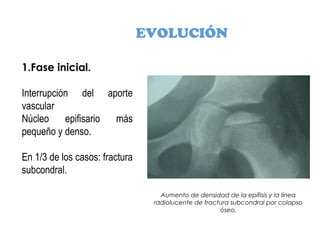 EVOLUCIÓN
1.Fase inicial.
Interrupción del aporte
vascular
Núcleo epifisario más
pequeño y denso.
En 1/3 de los casos: fractura
subcondral.
Aumento de densidad de la epífisis y la línea
radiolucente de fractura subcondral por colapso
óseo.
 