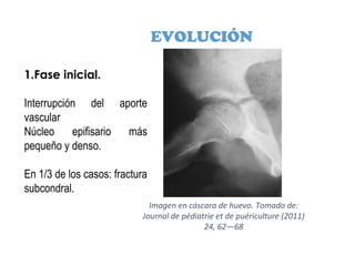 EVOLUCIÓN
1.Fase inicial.
Interrupción del aporte
vascular
Núcleo epifisario más
pequeño y denso.
En 1/3 de los casos: fractura
subcondral.
Imagen en cáscara de huevo. Tomado de:
Journal de pédiatrie et de puériculture (2011)
24, 62—68
 