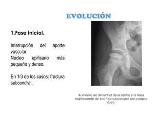 EVOLUCIÓN
1.Fase inicial.
Interrupción del aporte
vascular
Núcleo epifisario más
pequeño y denso.
En 1/3 de los casos: fractura
subcondral.
Aumento de densidad de la epífisis y la línea
radiolucente de fractura subcondral por colapso
óseo.
 