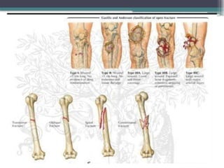 Leg Small Injury leg injuries in emergency medicinee.pptx