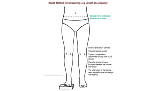 Leg Length Measurement true and apparent measurement limb length ...