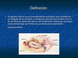Definición El legrado uterino es un procedimiento quirúrgico que consiste en un raspado de la mucosa o membrana que recubre al útero con el fin de eliminar tejido del útero o del endometrio utilizando una legra (instrumento lago con forma de cuchara) para examinarlo posteriormente.   