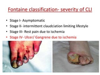 Fontaine classification- severity of CLI 
• Stage I- Asymptomatic 
• Stage II- intermittent claudciation limiting lifestyle 
• Stage III- Rest pain due to ischemia 
• Stage IV- Ulcer/ Gangrene due to ischemia 
 