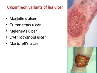 Uncommon variants of leg ulcer 
• Marjolin’s ulcer 
• Gummatous ulcer 
• Meleney’s ulcer 
• Erythrocyanoid ulcer 
• Martorell’s ulcer 
 