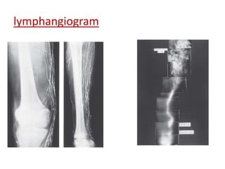 lymphangiogram 
 