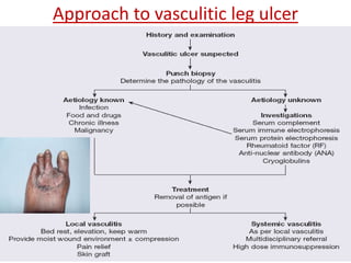 Approach to vasculitic leg ulcer 
 