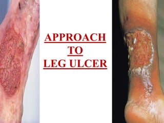 APPROACH 
TO 
LEG ULCER 
 