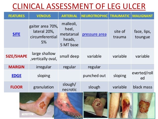 diabetic ulcer on leg - pictures, photos