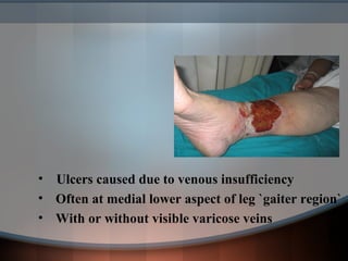 • Ulcers caused due to venous insufficiency
• Often at medial lower aspect of leg `gaiter region`
• With or without visible varicose veins
 