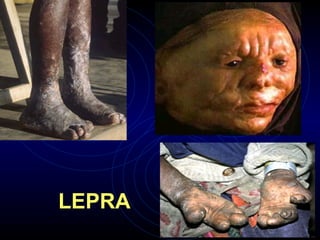 LEPRA
 