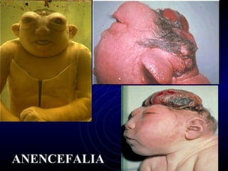 ANENCEFALIA
 