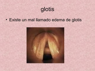 glotis
• Existe un mal llamado edema de glotis
 