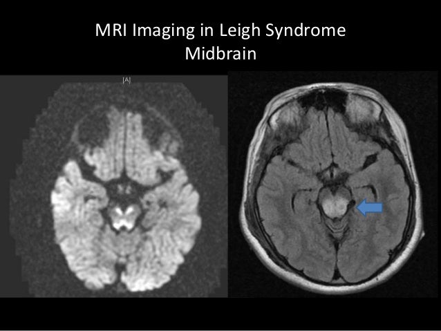 Leigh Syndrome Mri