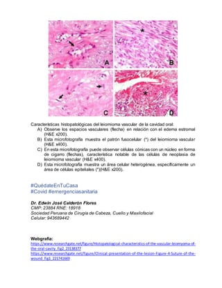Características histopatológicas del leiomioma vascular de la cavidad oral:
A) Observe los espacios vasculares (flecha) en relación con el edema estromal
(H&E x200).
B) Esta microfotografía muestra el patrón fusocelular (*) del leiomioma vascular
(H&E x400).
C) En esta microfotografía puede observar células cónicas con un núcleo en forma
de cigarro (flechas), característica notable de las células de neoplasia de
leiomioma vascular (H&E x400).
D) Esta microfotografía muestra un área celular heterogénea, específicamente un
área de células epiteliales (*)(H&E x200).
#QuédateEnTuCasa
#Covid #emergenciasanitaria
Dr. Edwin José Calderón Flores
CMP: 23884 RNE: 18918
Sociedad Peruana de Cirugía de Cabeza, Cuello y Maxilofacial
Celular: 943689442
Webgrafia:
https://www.researchgate.net/figure/Histopatological-characteristics-of-the-vascular-leiomyoma-of-
the-oral-cavity_fig2_23138377
https://www.researchgate.net/figure/Clinical-presentation-of-the-lesion-Figure-4-Suture-of-the-
wound_fig1_221741669