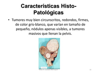 Características Histo-
Patológicas
• Tumores muy bien circunscritos, redondos, firmes,
de color gris-blanco, que varían en tamaño de
pequeño, nódulos apenas visibles, a tumores
masivos que llenan la pelvis.
10Jesús A. Custodio Marroquín
 