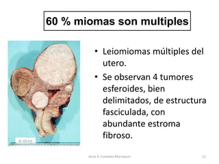 • Leiomiomas múltiples del
utero.
• Se observan 4 tumores
esferoides, bien
delimitados, de estructura
fasciculada, con
abundante estroma
fibroso.
60 % miomas son multiples
11Jesús A. Custodio Marroquín
 