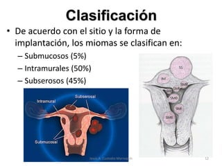 Clasificación
• De acuerdo con el sitio y la forma de
implantación, los miomas se clasifican en:
– Submucosos (5%)
– Intramurales (50%)
– Subserosos (45%)
12Jesús A. Custodio Marroquín
 