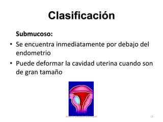 Clasificación
Submucoso:
• Se encuentra inmediatamente por debajo del
endometrio
• Puede deformar la cavidad uterina cuando son
de gran tamaño
13Jesús A. Custodio Marroquín
 