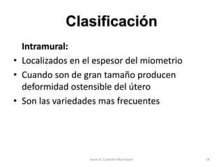 Clasificación
Intramural:
• Localizados en el espesor del miometrio
• Cuando son de gran tamaño producen
deformidad ostensible del útero
• Son las variedades mas frecuentes
14Jesús A. Custodio Marroquín
 