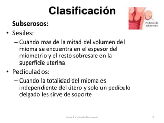 Clasificación
Subserosos:
• Sesiles:
– Cuando mas de la mitad del volumen del
mioma se encuentra en el espesor del
miometrio y el resto sobresale en la
superficie uterina
• Pediculados:
– Cuando la totalidad del mioma es
independiente del útero y solo un pedículo
delgado les sirve de soporte
15Jesús A. Custodio Marroquín
 