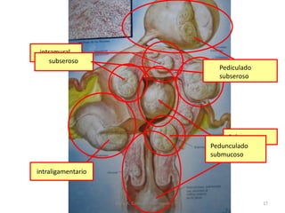 Submucoso
Pedunculado
submucoso
intramural
subseroso
Pediculado
subseroso
intraligamentario
17Jesús A. Custodio Marroquín
 